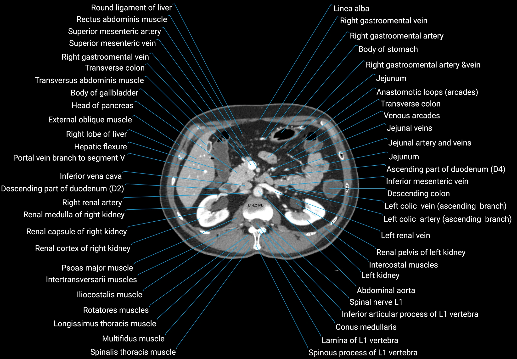 CT male pelvis axial cross sectional anatomy labelled radiology image -00064.webp